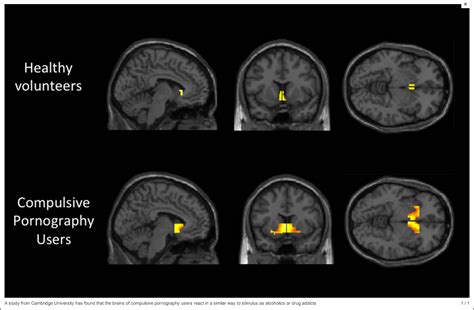 porn causes brain damage|Pornography addiction: A neuroscience perspective